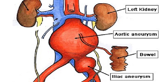 Abdominal Aortic Aneurysm Aaa Vascular Society