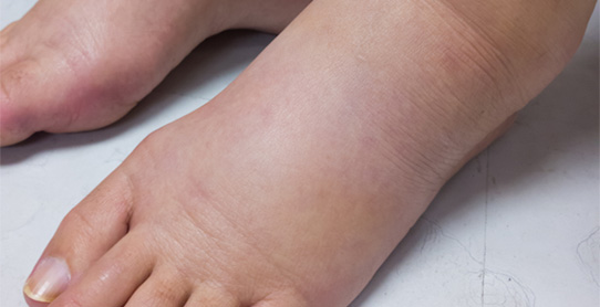 Leg swelling (Peripheral edema)