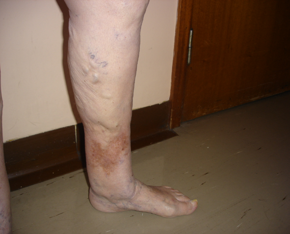 varicose bruise