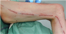 Peripheral Arterial Bypass Graft